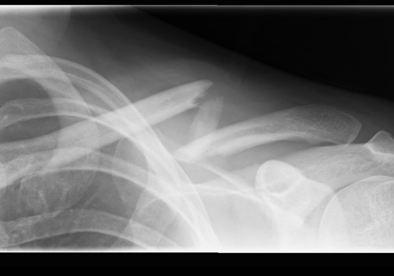 Clavicle Fracture Displaced